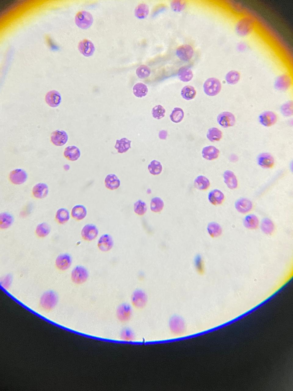 Microscope view of a stained blood smear taken in the clinic lab